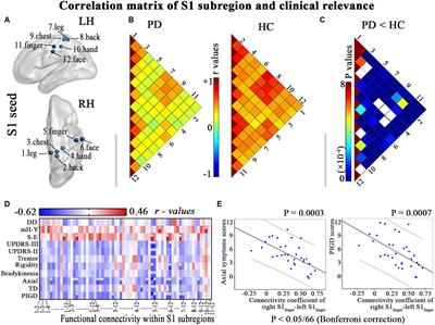 Hypo-connectivity of the primary somatosensory cortex in Parkinson’s disease: a resting-state functional MRI study